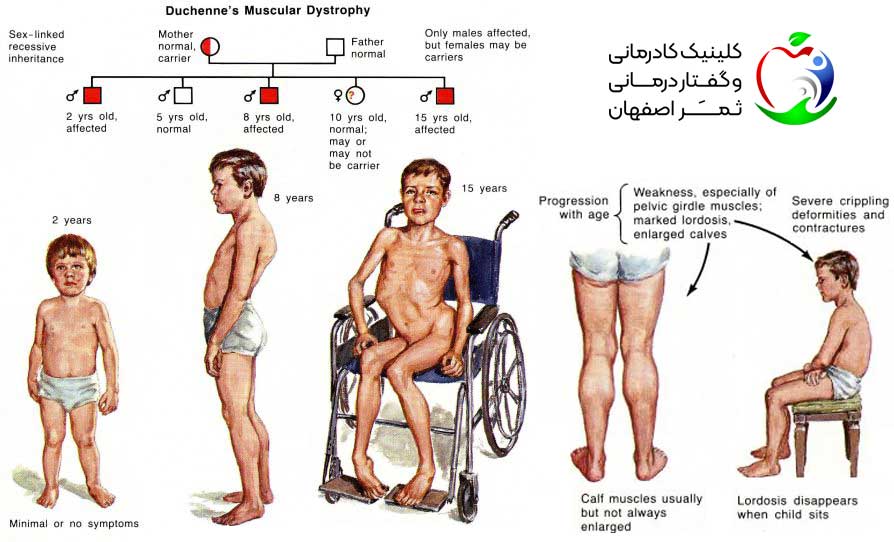 اختلالات عضلانی